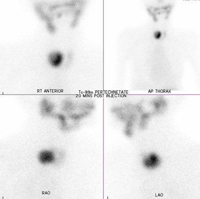 Thyroid Case 5