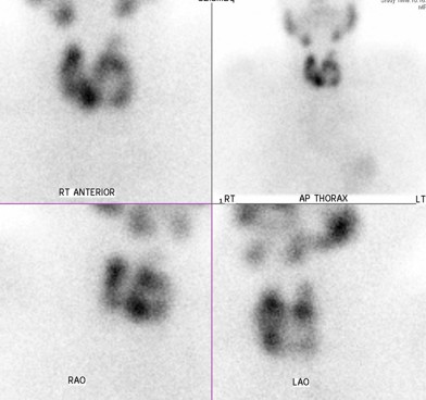 Thyroid Case 6