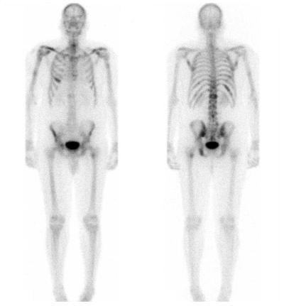 Recent CT showed liver and adrenal metastases. Low right posterior chest 