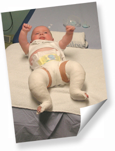 Photo of Baby Harley with both legs in plasters.  Click for photogallery and full description of each photo