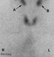 thyroid image 1