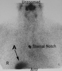 thyroid image 3b