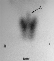 thyroid image 2a