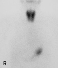 thyroid image 2e