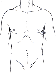 Description: open prostatectomy