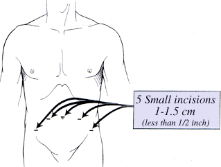 Description: laparoscopic prostatectomy