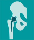 Hemiarthroplasty Diagram