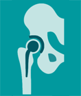 Total Hip Replacement Diagram