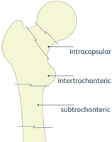 Diagram showing types of hip fracture